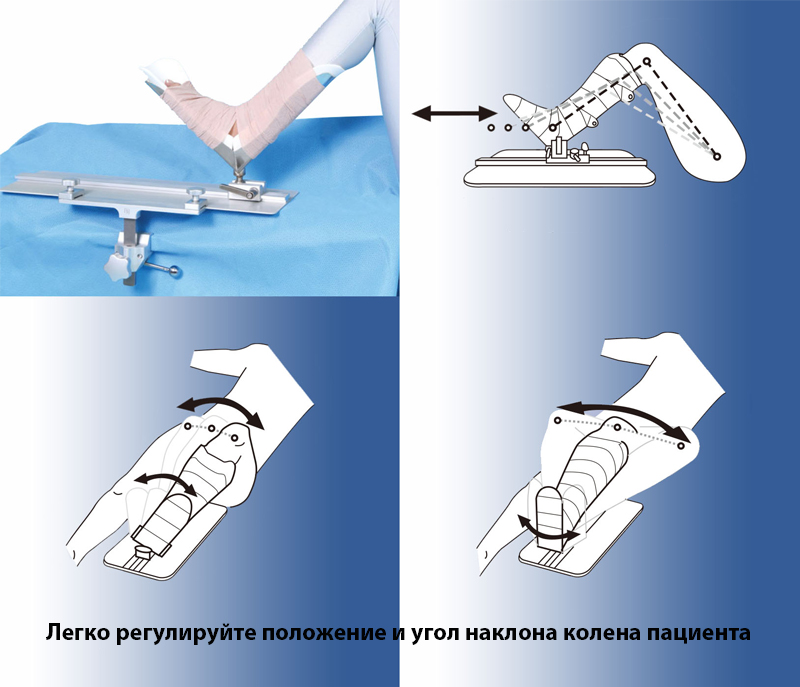 Фиксатор для хирургии коленного сустава