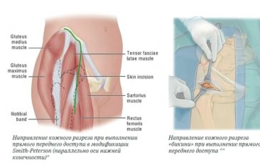 Эндопротезирование тазобедренного сустава DAA